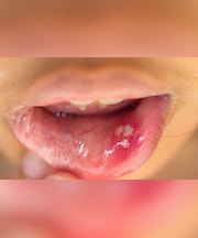 मुंह के छालों से राहत पाने में मदद करेंगे 3 घरेलू नुस्खे, तुरंत आजमाएं और छालों से हमेशा के लिए छुटकारा पाएं