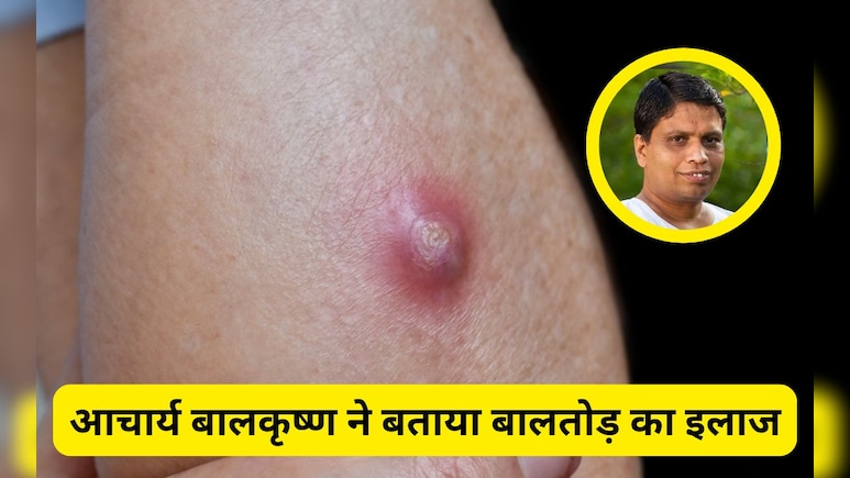 बालतोड़ का इलाज जल्दी कैसे करें? Acharya Balkrishna ने बताया कैसे ठीक होंगे ये फोड़े