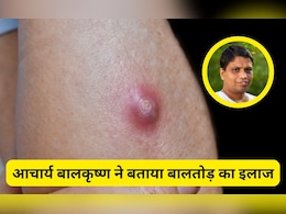 बालतोड़ का इलाज जल्दी कैसे करें? Acharya Balkrishna ने बताया कैसे ठीक होंगे ये फोड़े बालतोड़ का इलाज जल्दी कैसे करें? Acharya Balkrishna ने बताया कैसे ठीक होंगे ये फोड़े