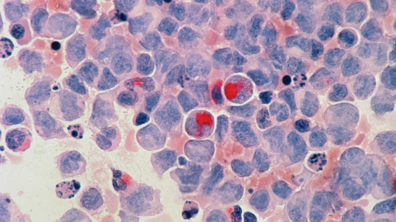 कैंसर के 5 कॉमन लक्षण, जो लगते हैं छोटी सी समस्‍या, पर हैं बड़ा खतरा