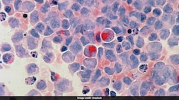 From Diet To Vaccine: Doctor Discusses 6 Ways To Prevent Majority Of Cancers