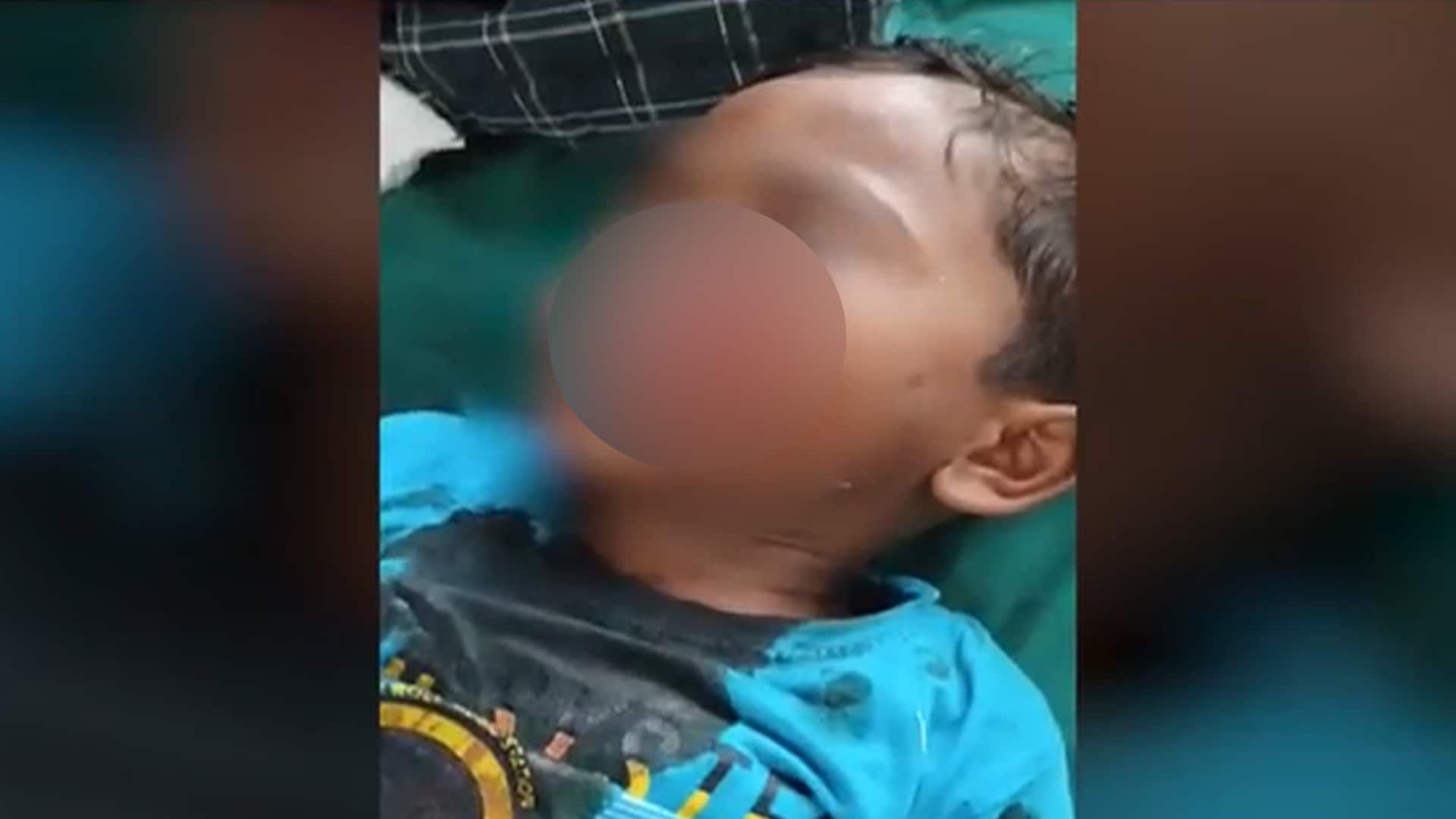 4-Year-Old Injured in Stray Dog Attack in Maharashtra's Bhandara District