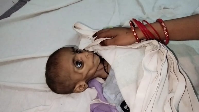 Malnutrition In Madhya Pradesh: Another Child Dead, Rehab Admissions Rise Malnutrition In Madhya Pradesh: Another Child Dead, Rehab Admissions Rise
