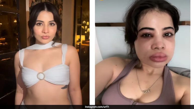 Uorfi Javed Gets Lip Fillers Dissolved After 9 Years, Shares Video Of Swollen And Healed Face Uorfi Javed Gets Lip Fillers Dissolved After 9 Years, Shares Video Of Swollen And Healed Face