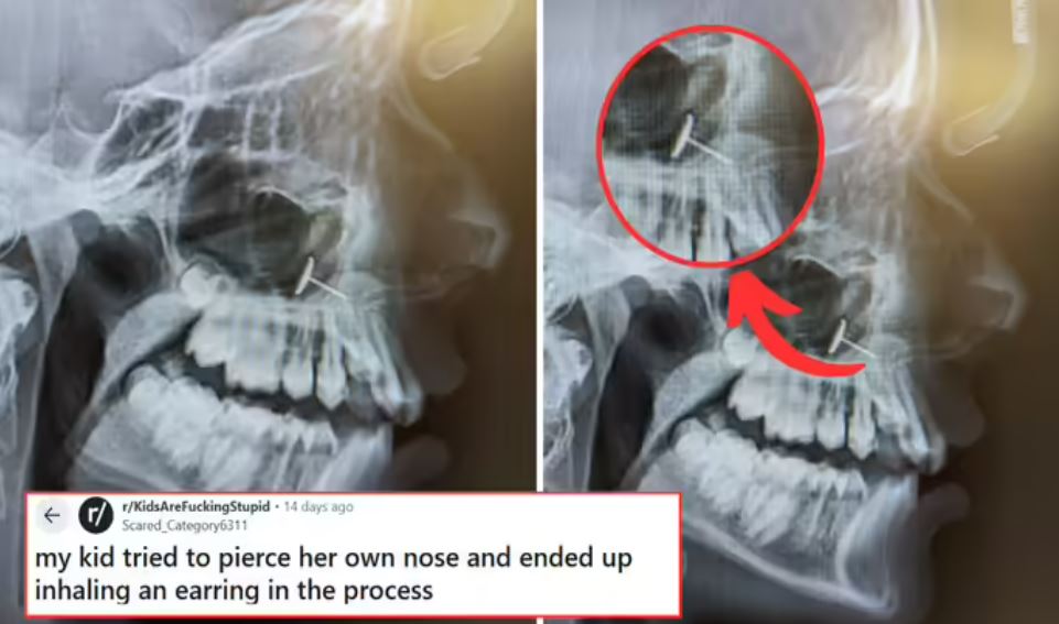 दांत के X-ray से खुली लड़की की चोरी, रिपोर्ट देखकर चौंके डॉक्टर