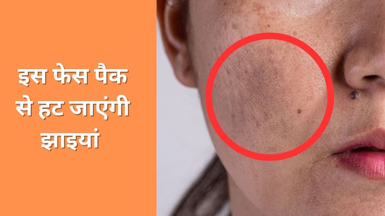 झाईयां जल्दी कैसे मिटती है? आयुर्वेदिक डॉक्टर ने बताया पिग्मेंटेशन से लेकर दाग धब्बे दूर करने के लिए लगा लें यह फेस पैक झाईयां जल्दी कैसे मिटती है? आयुर्वेदिक डॉक्टर ने बताया पिग्मेंटेशन से लेकर दाग धब्बे दूर करने के लिए लगा लें यह फेस पैक