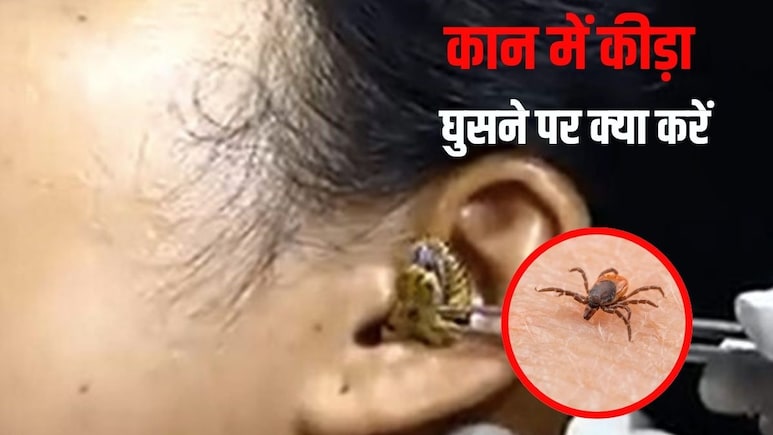 कान में अगर कोई कीड़ा घुस जाए तो क्या करें? क्या हम कीड़ों को दूर करने के लिए कान में पानी डाल सकते हैं