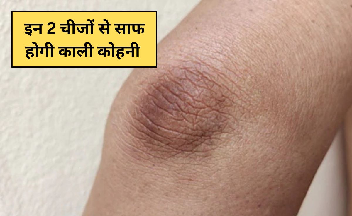 काली कोहनी पर जबरदस्त असर दिखाएंगी ये 2 चीजें, डॉक्टर ने कहा आप भी कर सकते हैं ये काम