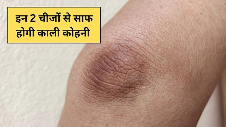 काली कोहनी पर जबरदस्त असर दिखाएंगी ये 2 चीजें, डॉक्टर ने कहा आप भी कर सकते हैं ये काम