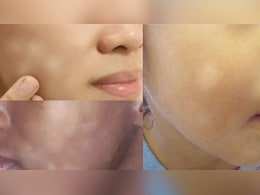 मां-बाप की गलती से बच्चों के चेहरे पर आ रहे हैं सफेद धब्बे, नहीं सुधरे आप तो नुकसान झेलना पड़ेगा बेटी-बेटे को मां-बाप की गलती से बच्चों के चेहरे पर आ रहे हैं सफेद धब्बे, नहीं सुधरे आप तो नुकसान झेलना पड़ेगा बेटी-बेटे को