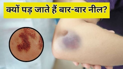 बिना चोट के बार-बार पड़ जाते हैं नील? शरीर में हो सकती है इन चीजों की कमी, डॉक्टर से जान लें