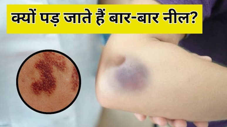 बिना चोट के बार-बार पड़ जाते हैं नील? शरीर में हो सकती है इन चीजों की कमी, डॉक्टर से जान लें