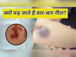 बिना चोट के बार-बार पड़ जाते हैं नील? शरीर में हो सकती है इन चीजों की कमी, डॉक्टर से जान लें बिना चोट के बार-बार पड़ जाते हैं नील? शरीर में हो सकती है इन चीजों की कमी, डॉक्टर से जान लें
