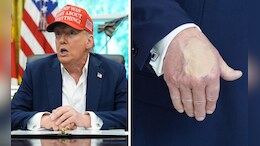 Trump's Hand Bruise, Makeup Is Viral Again. What The White House Said In Past
