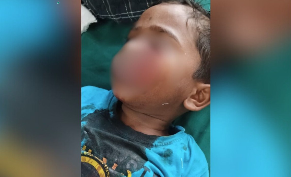 4-Year-Old Boy's Face Bitten Off By Stray Dogs In Maharashtra