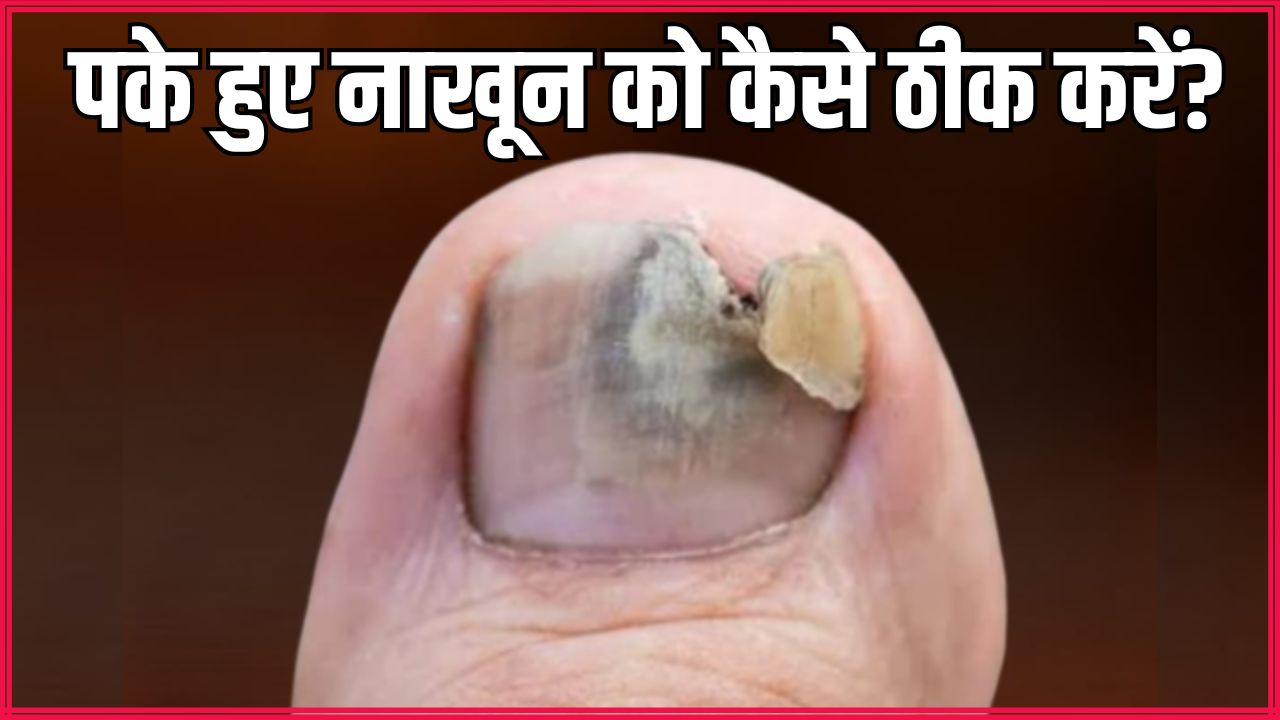 पैर का नाखून पक जाए तो क्या करें? आयुर्वेदिक न्यूट्रिशनिस्ट ने बताया 15 दिन में काले-पीले नेल्स ठीक करने का असरदार नुस्खा
