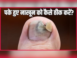 पैर का नाखून पक जाए तो क्या करें? आयुर्वेदिक न्यूट्रिशनिस्ट ने बताया 15 दिन में काले-पीले नेल्स ठीक करने का असरदार नुस्खा