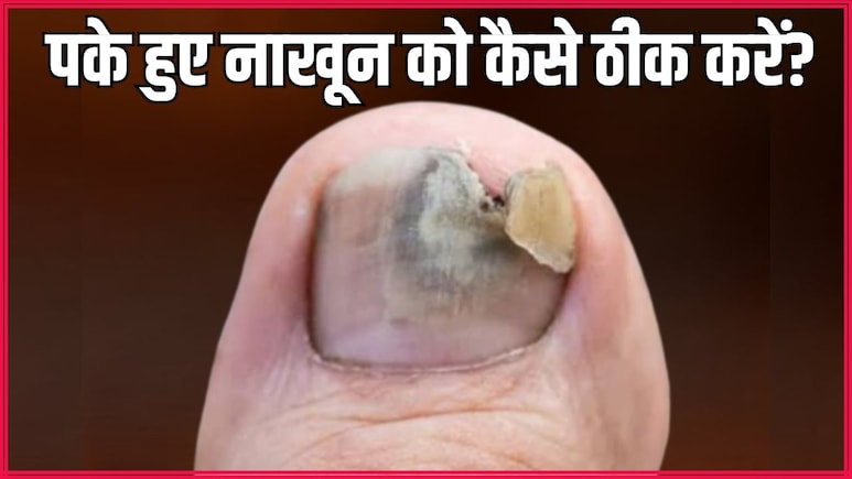 पैर का नाखून पक जाए तो क्या करें? आयुर्वेदिक न्यूट्रिशनिस्ट ने बताया 15 दिन में काले-पीले नेल्स ठीक करने का असरदार नुस्खा पैर का नाखून पक जाए तो क्या करें? आयुर्वेदिक न्यूट्रिशनिस्ट ने बताया 15 दिन में काले-पीले नेल्स ठीक करने का असरदार नुस्खा