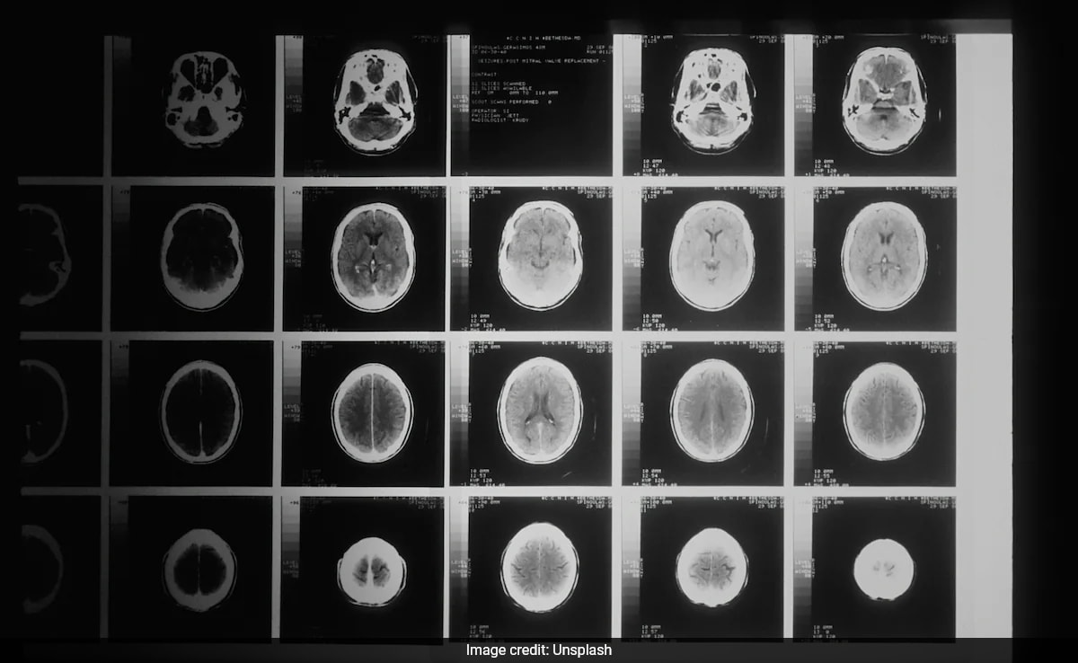 Новите изследвания установяват че стареенето на мозъка може да се