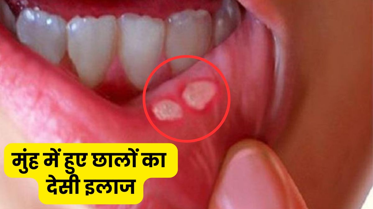 मिनटों में गायब होंगे मुंह के बड़े-बड़े छाले, छुटकारा पाने के लिए आजमाएं ये घरेलू नुस्खा