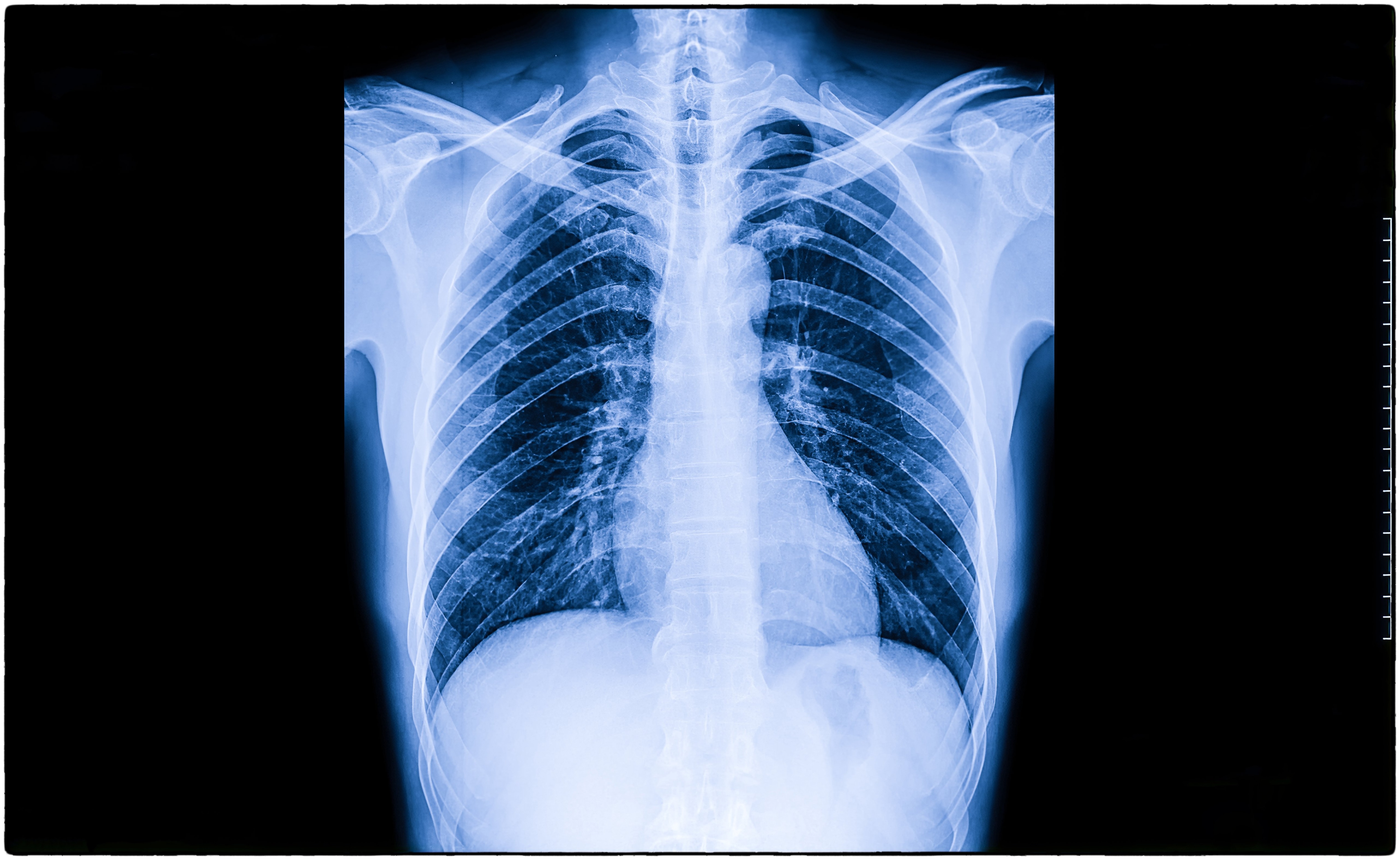 Experts Warn India's Future At Risk As Young Lungs Deteriorating, Struggle To Breathe