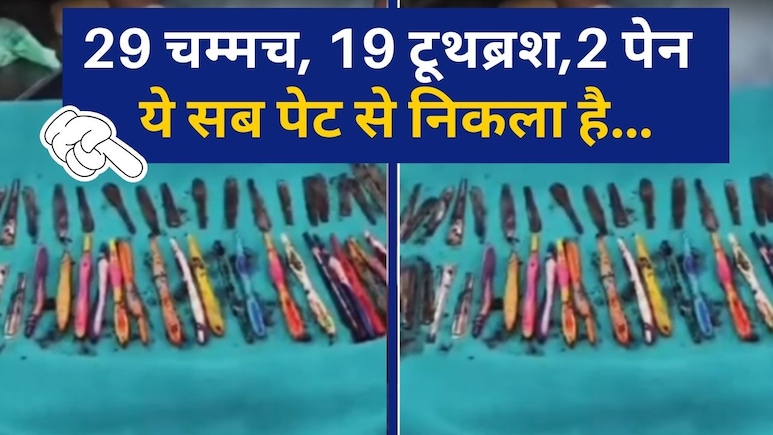 आदमी के पेट से न‍िकले 29 चम्मच, 19 टूथब्रश और 2 पेन, इस अजीब बीमारी के चलते खाता था ये सब