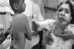 Brutal Stray Dog Attack In Karnataka's Honnali: 4 Children, 1 Elderly Injured Brutal Stray Dog Attack In Karnataka's Honnali: 4 Children, 1 Elderly Injured