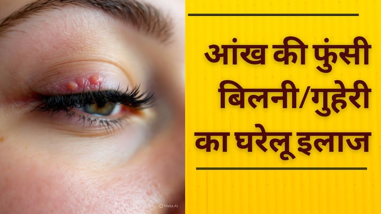 क्‍यों हो जाती है आंख की फुंसी/बिलनी/गुहेरी या Eye Stye , जानें इसके कारण, इलाज और बचाव