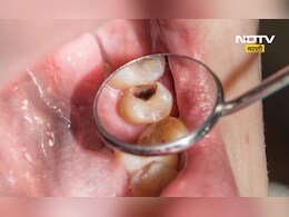 दाढेतील किड कशी काढाल? Cavity दूर करण्यासाठी रामबाण घरगुती उपाय