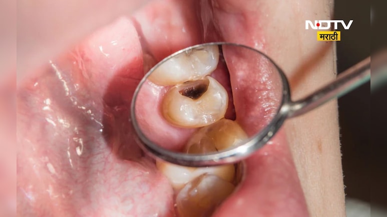 दाढेतील किड कशी काढाल? Cavity दूर करण्यासाठी रामबाण घरगुती उपाय दाढेतील किड कशी काढाल? Cavity दूर करण्यासाठी रामबाण घरगुती उपाय