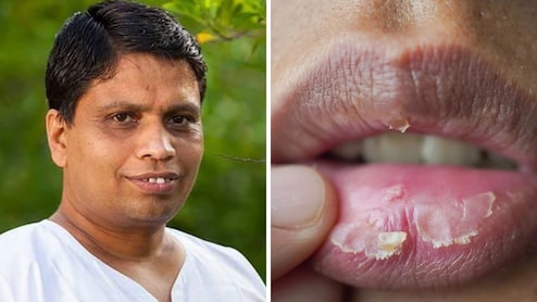 Acharya Balkrishna ने बताया रूखे-फटे होंठों का असरदार नुस्खा, नाभि में डालकर सो जाएं ये तेल, सुबह तक मुलायम दिखने लगेंगे Lips