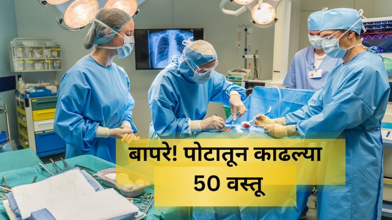 Shocking News: अरे देवा! तरुणाच्या पोटात 29 चमचे अन् 19 ब्रश; असं घडलं तरी कसं? डॉक्टरही हादरले