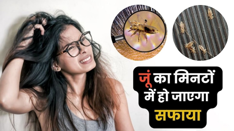 जूं के कारण खुजला-खुजला कर ल‍िया है स‍िर में घाव, ये 3 चीजें लगाते ही सब मर जाएंगी