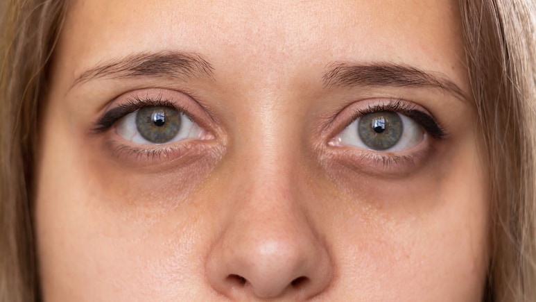 Dark Circles Remedies: डार्क सर्कलमुळे तुमचे सौंदर्य बिघडलंय? हा उपाय केल्यास डोळे दिसतील प्रचंड सुंदर
