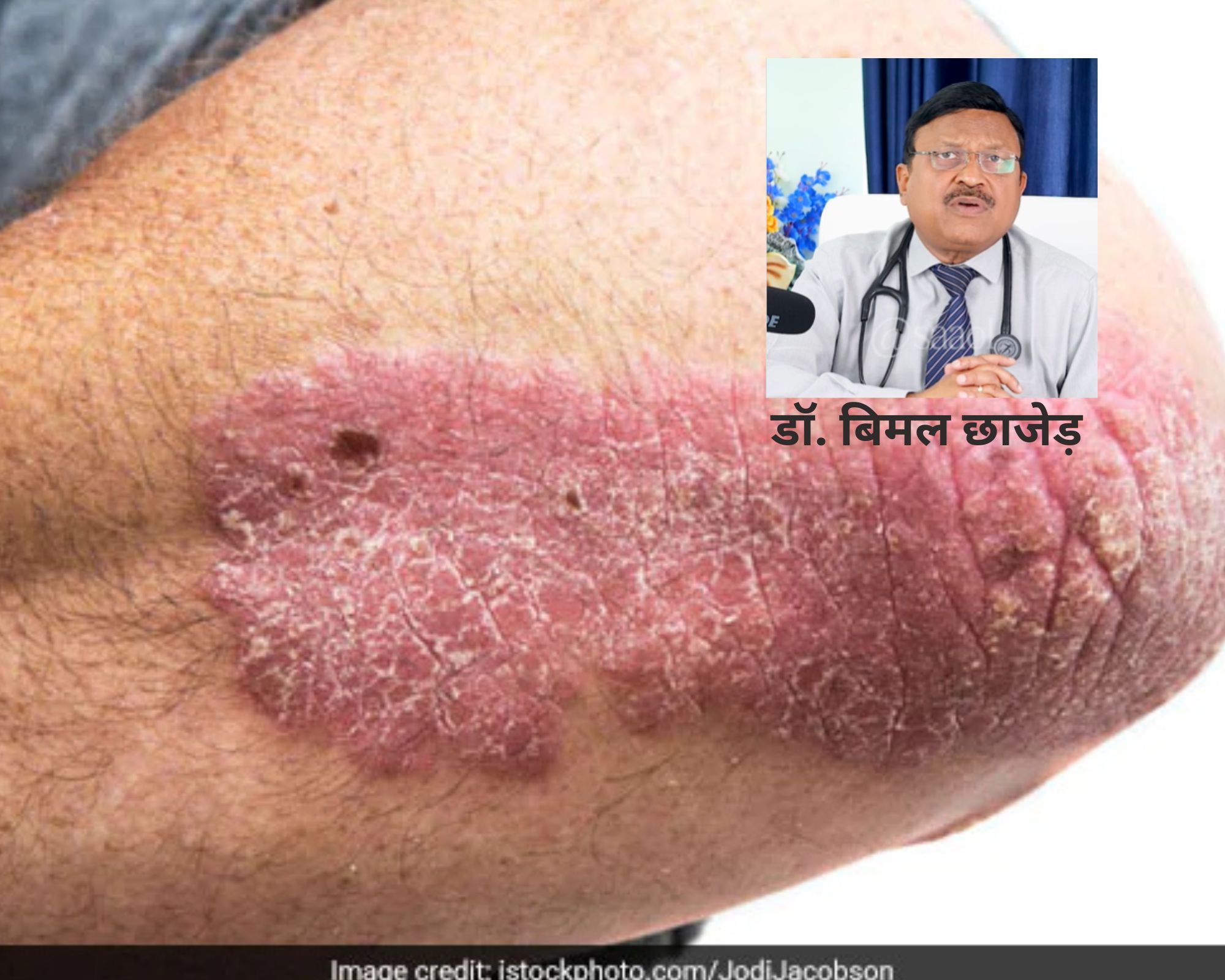 डॉक्टर ने बताया Psoriasis का इलाज, बार-बार खुजलाने से मिलेगा आराम...