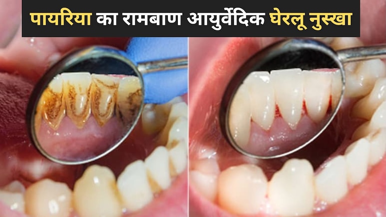 दांतों का पायरिया कैसे ठीक करें? Dr. Deepak Kumar ने बताया दांत की सभी समस्याओं का एक कारगर घरेलू उपाय