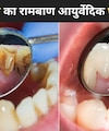 मुंह की बदबू, मसूड़ों से खून आना, Doctor ने बताया पायरिया का फिटकरी से बनने वाला कारगर घरेलू इलाज