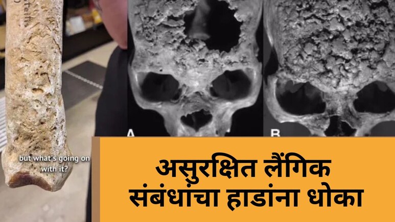 Syphilis: केवळ एड्सच नाही, तर हा लैंगिक आजार तुमच्या हाडांचीही करतो राख! वेळीच ओळखा ही लक्षणं...