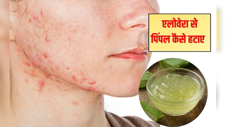 मुंहासों के लिए चेहरे पर एलोवेरा कैसे लगाएं? 99% लड़कियों को नहीं पता है लगाने का सही तरीका, अब एक्ने का हो जाएगा जड़ से खात्मा मुंहासों के लिए चेहरे पर एलोवेरा कैसे लगाएं? 99% लड़कियों को नहीं पता है लगाने का सही तरीका, अब एक्ने का हो जाएगा जड़ से खात्मा