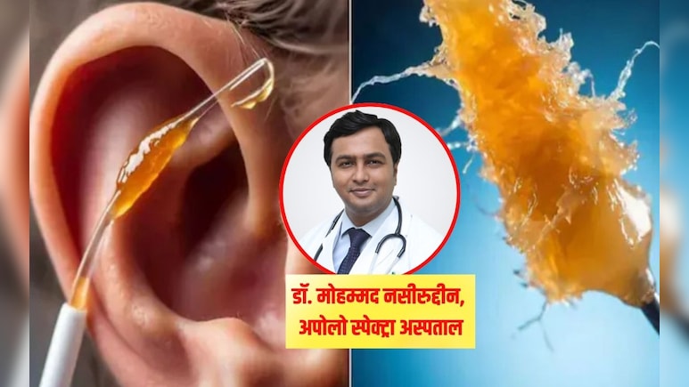 Apollo डॉक्‍टर ने बताएं कान का मैल हटाने के सबसे 3 सुरक्षित तरीके, 10 सेकंड में कान का पीला मैल हो जाएगा बाहर