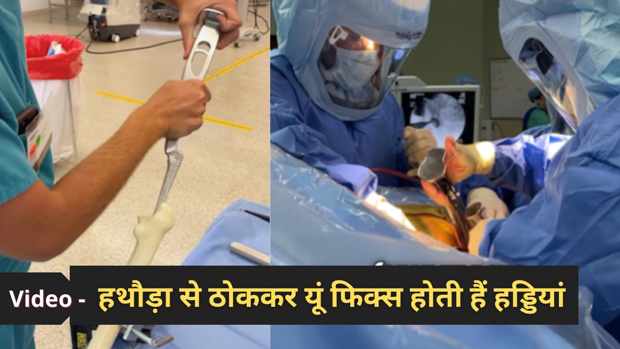 हिप रिप्लेसमेंट सर्जरी के मुश्किल 30 सेकंड तय करते हैं कितनी आसान होगी आगे की जिंदगी, देखें ऑर्थो सर्जन का वीडियो