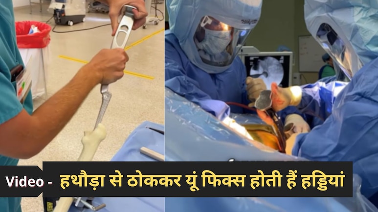 हिप रिप्लेसमेंट सर्जरी के मुश्किल 30 सेकंड तय करते हैं कितनी आसान होगी आगे की जिंदगी, देखें ऑर्थो सर्जन का वीडियो हिप रिप्लेसमेंट सर्जरी के मुश्किल 30 सेकंड तय करते हैं कितनी आसान होगी आगे की जिंदगी, देखें ऑर्थो सर्जन का वीडियो