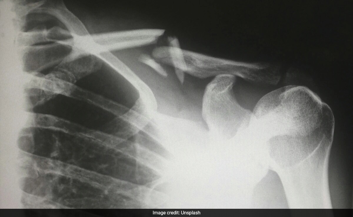 Modified Glue Gun 3D Prints Bone-Like Material for Fractures