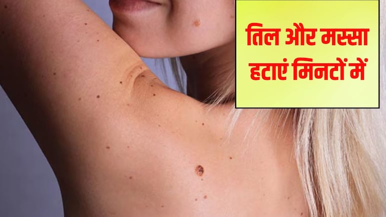 Tips and Tricks: त्‍वचा पर तिल को लेकर हैं परेशान? आजमाएं ये आसान घरेलू नुस्खे, बिना खर्च हो जाएगी ग्लोइंग स्किन