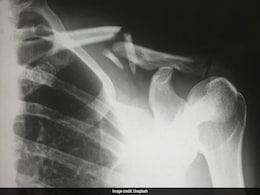 Researchers Develop Modified Glue Gun That Can Repair Complex Bone Fractures Researchers Develop Modified Glue Gun That Can Repair Complex Bone Fractures
