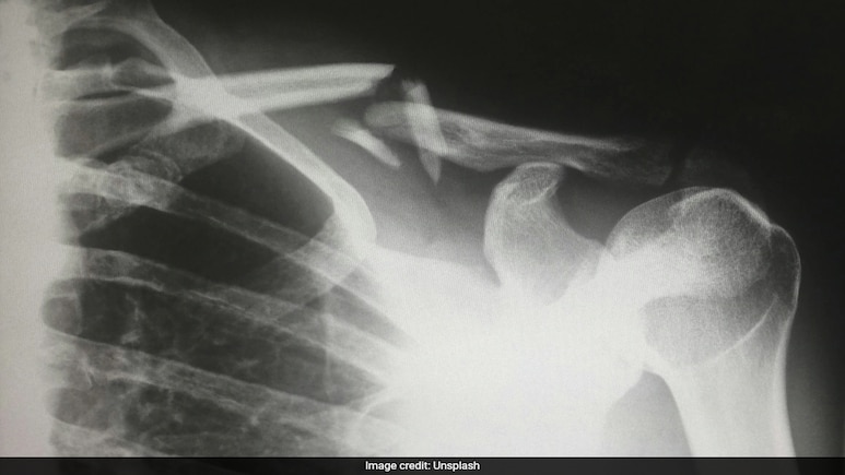 Researchers Develop Modified Glue Gun That Can Repair Complex Bone Fractures Researchers Develop Modified Glue Gun That Can Repair Complex Bone Fractures