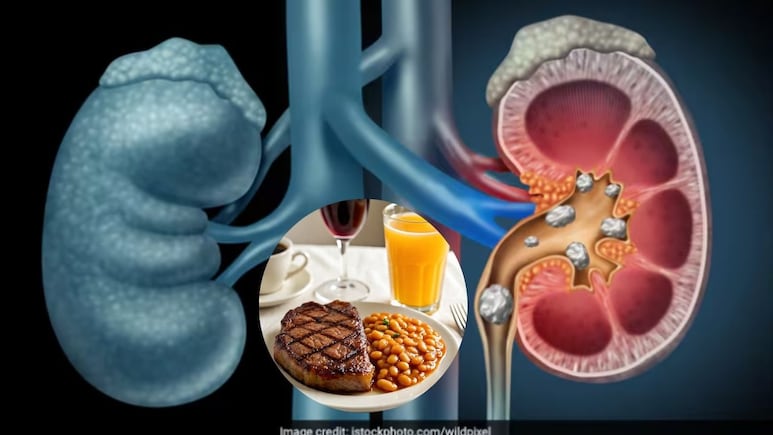 Kidney Stone होने पर खा लें ये 5 चीजें खुद बा खुद बाहर निकल जाएगी पथरी, फिर कभी नहीं होगी किडनी में पथरी की समस्या Kidney Stone होने पर खा लें ये 5 चीजें खुद बा खुद बाहर निकल जाएगी पथरी, फिर कभी नहीं होगी किडनी में पथरी की समस्या