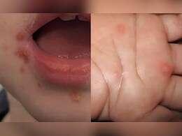 स्कूली बच्चों में तेजी से फैलता है 'हैंड, फुट एंड माउथ' वायरस, जानें लक्षण और बचाव