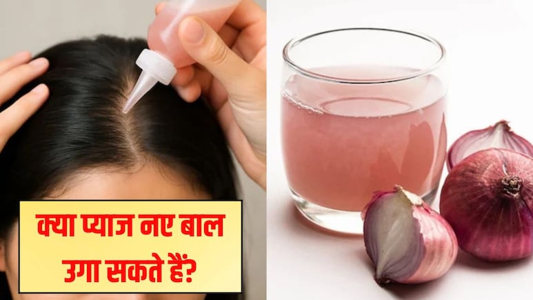 क्या प्याज नए बाल उगा सकते हैं? प्याज का रस बालों में कितनी देर लगाना चाहिए, जानिए यहां क्या प्याज नए बाल उगा सकते हैं? प्याज का रस बालों में कितनी देर लगाना चाहिए, जानिए यहां