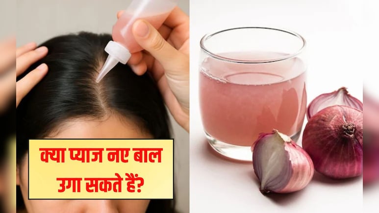 क्या प्याज नए बाल उगा सकते हैं? प्याज का रस बालों में कितनी देर लगाना चाहिए, जान‍िए यहां